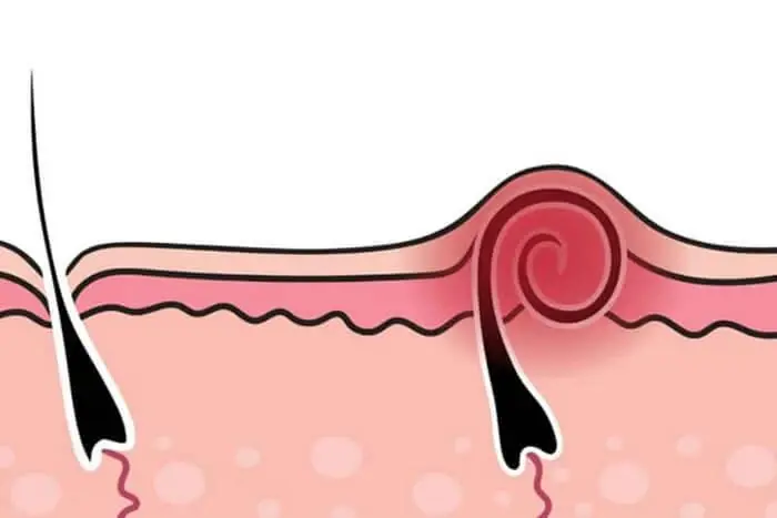 Comment traiter les poils incarnés